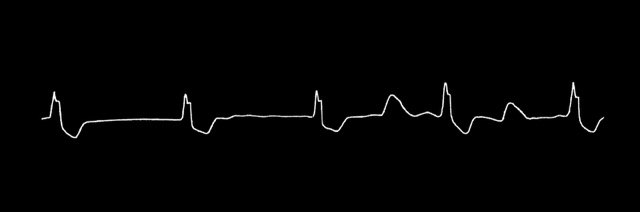 Sample ECG